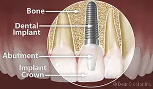 dental-implants