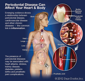 Periodontal (Gum) Disease 2